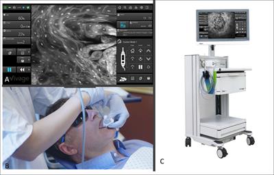 Acquisition and annotation in high resolution in vivo digital biopsy by confocal microscopy for diagnosis in oral precancer and cancer
